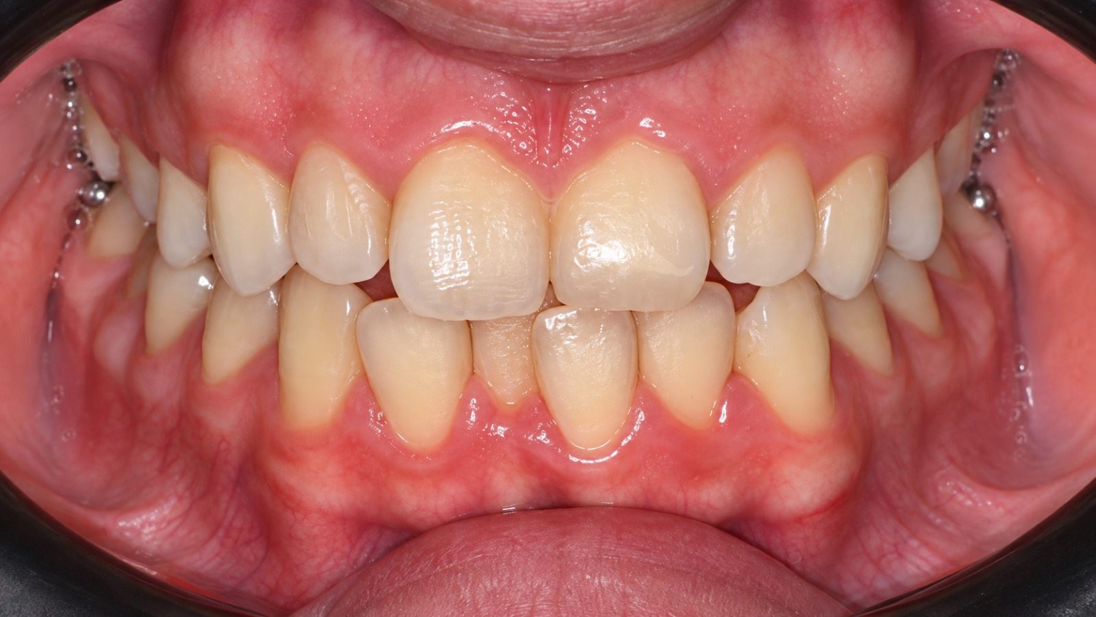 Before treatment