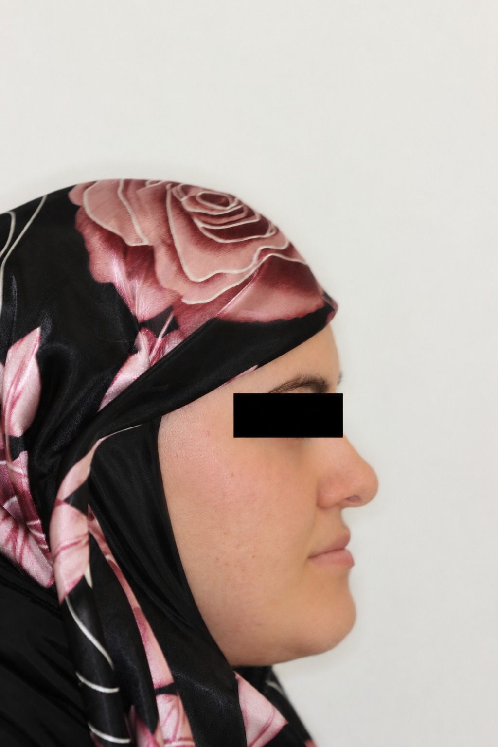 Before treatment