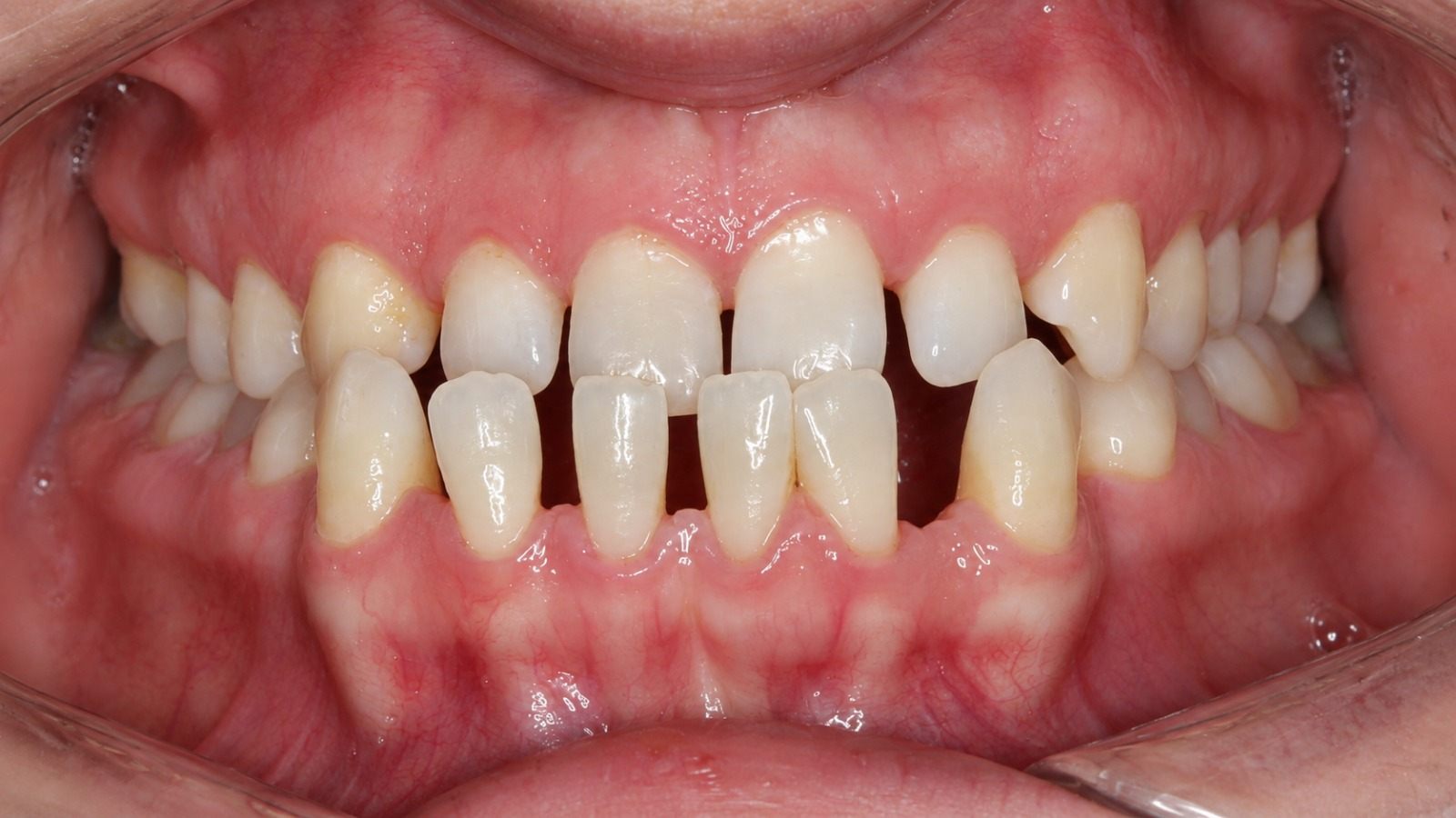 Before treatment