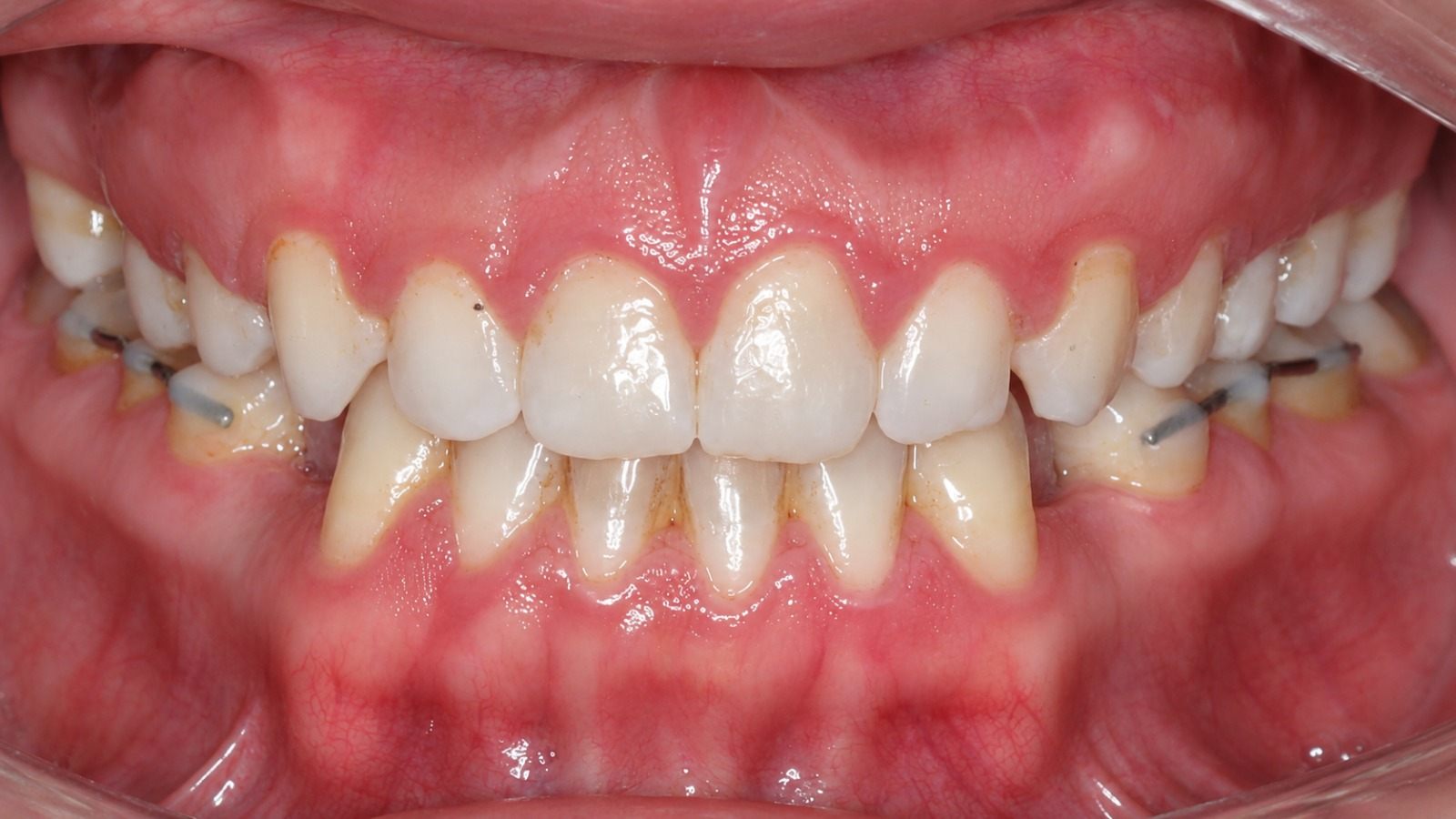 After treatment