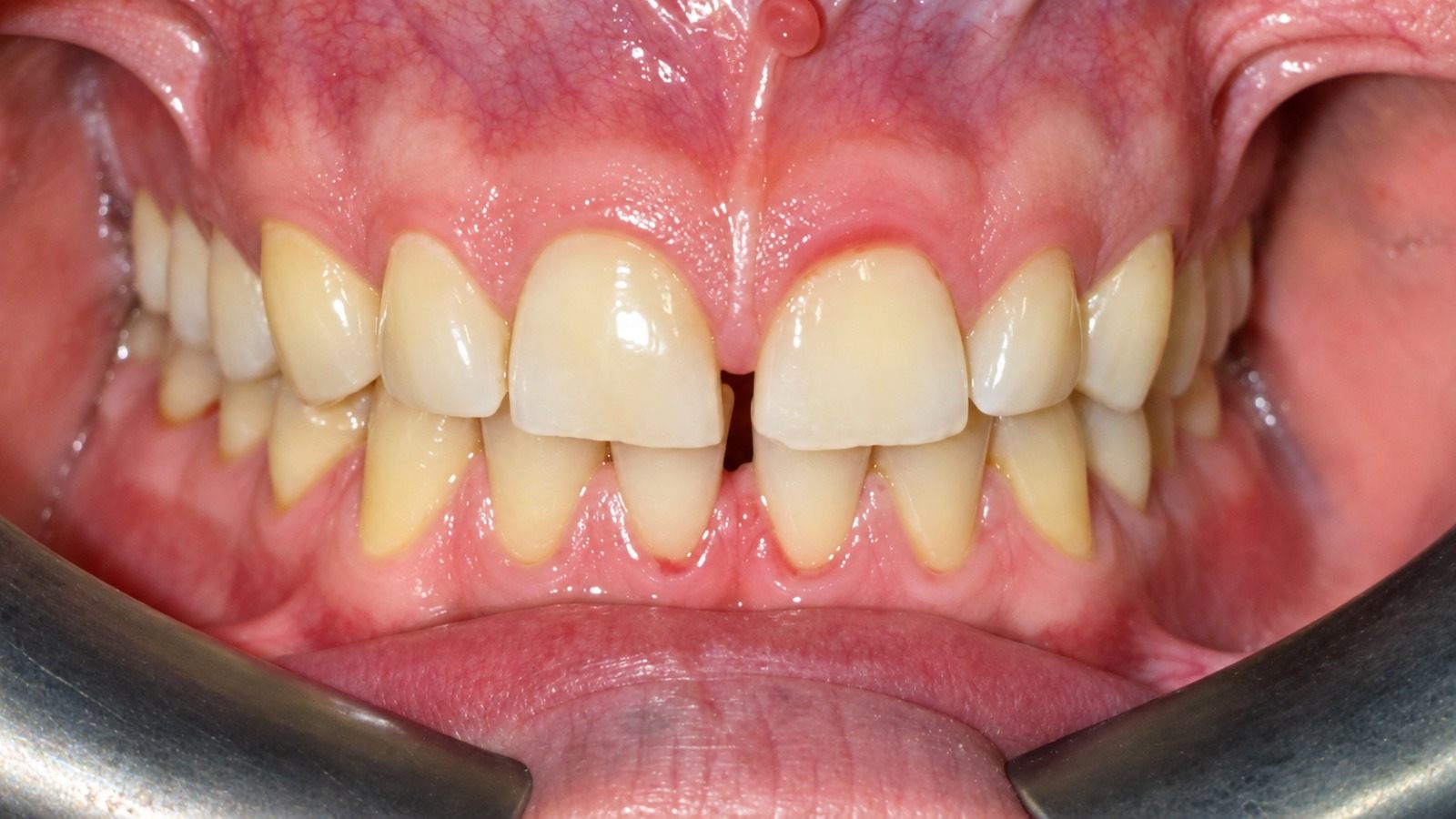 Before treatment