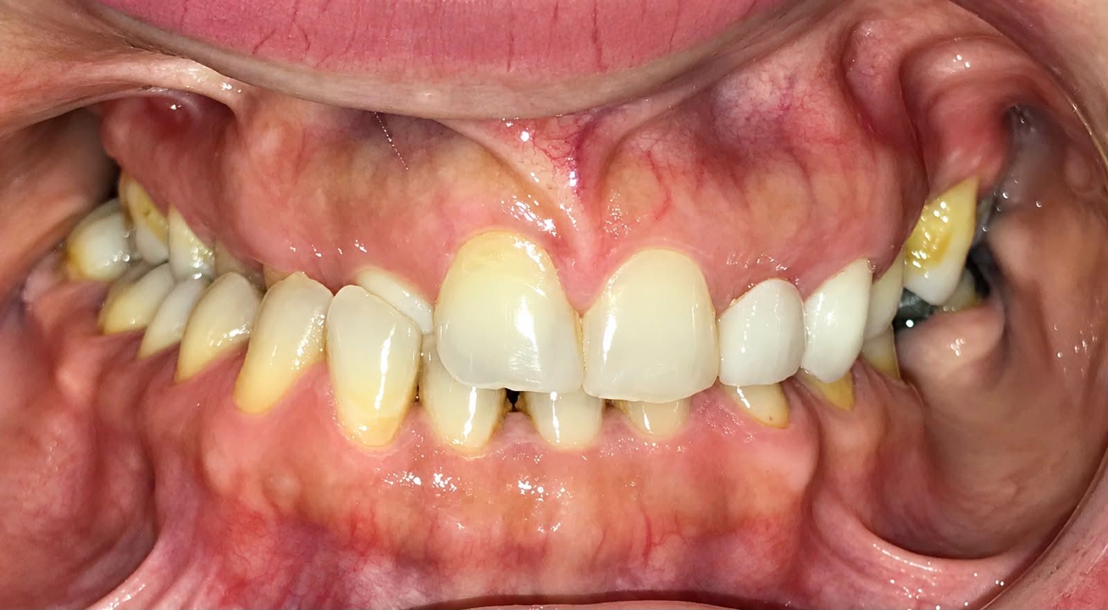 Pretreatment condition showing the crossbite, mandibular deviation, and severe midline discrepancy.