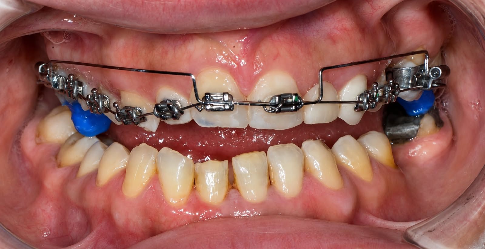 Orthodontic treatment in progress, with correction of the occlusion and dental midlines.