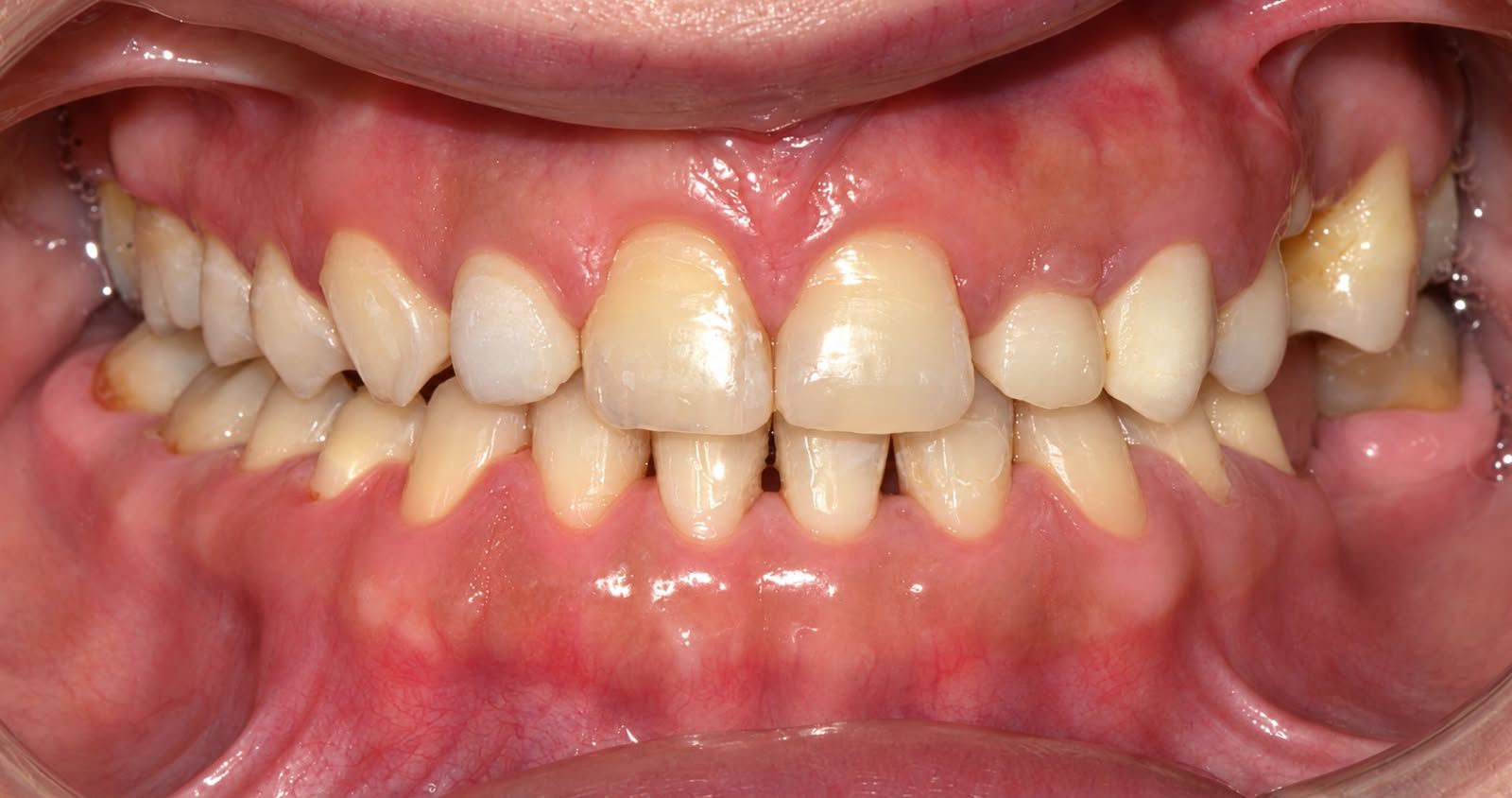 Completion of the orthodontic phase, with the teeth positioned appropriately to receive the definitive esthetic restorations.