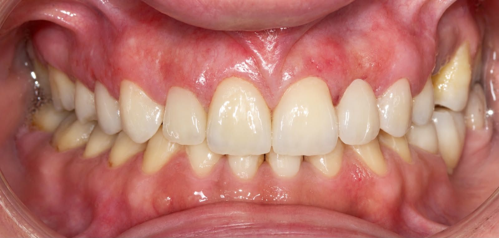 Final result following placement of veneers and esthetic crowns, achieving harmonious esthetics and functional occlusion in this complex multidisciplinary case.