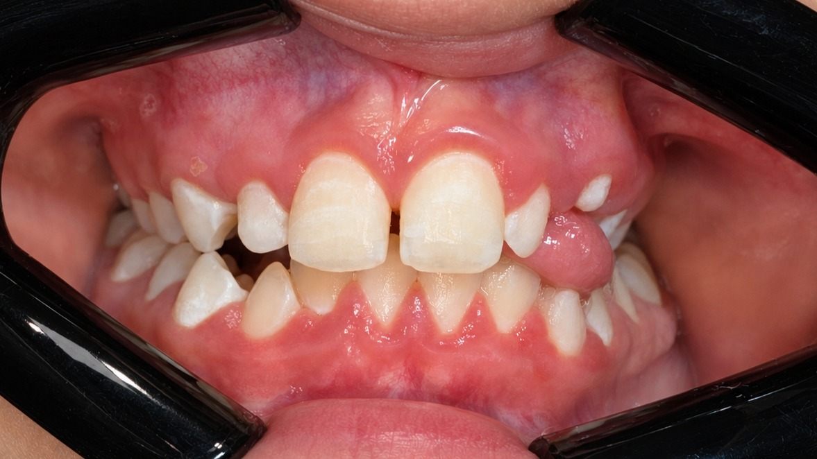 Initial presentation showing maxillary constriction, a marked midline deviation, functional mandibular shift, and complete lack of space for eruption of the upper right canine.