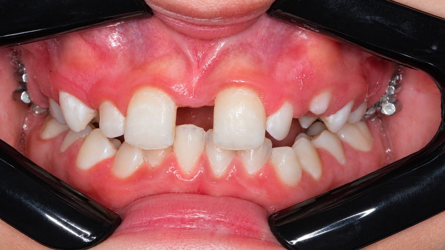 Rapid maxillary expansion (RME) was initiated to correct the transverse maxillary constriction.