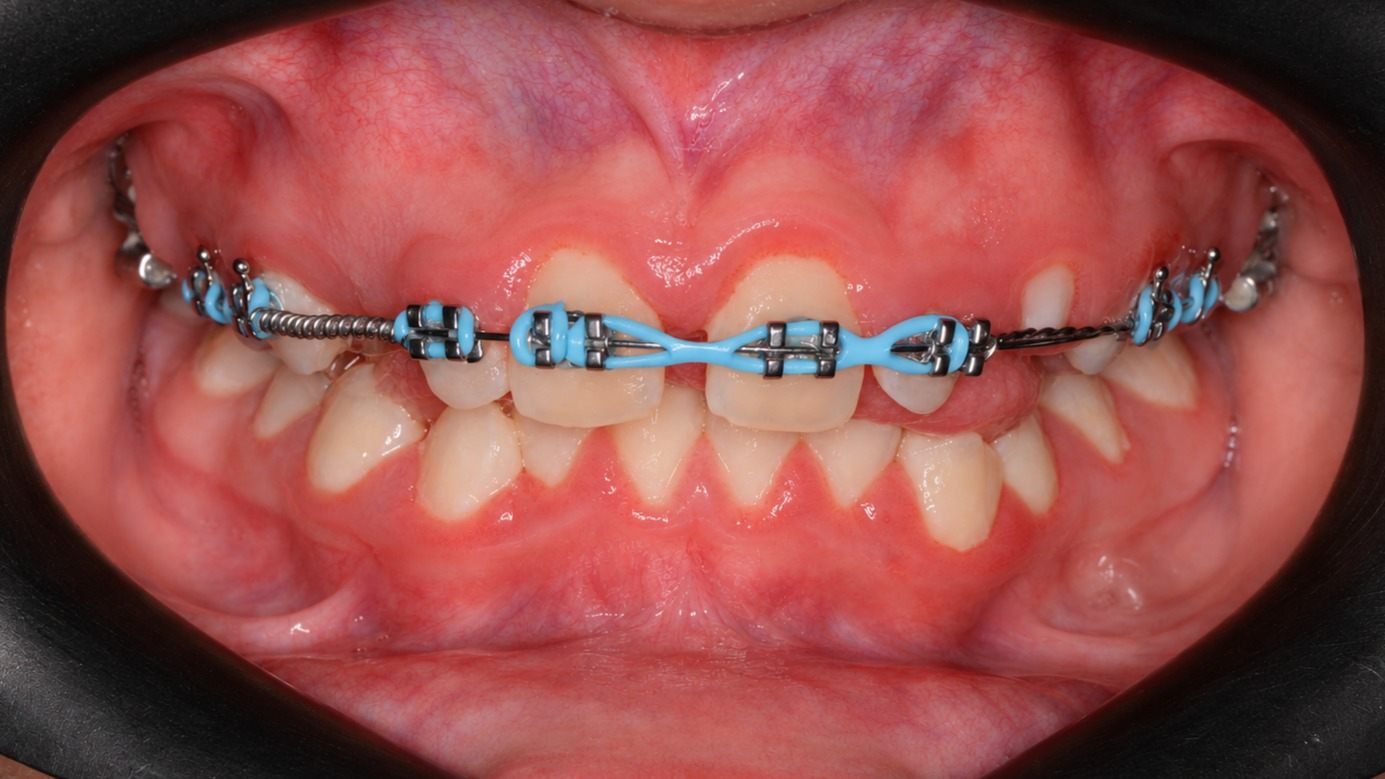 The space gained through expansion was utilized to create adequate space for the upper right canine, with significant improvement of the midline.