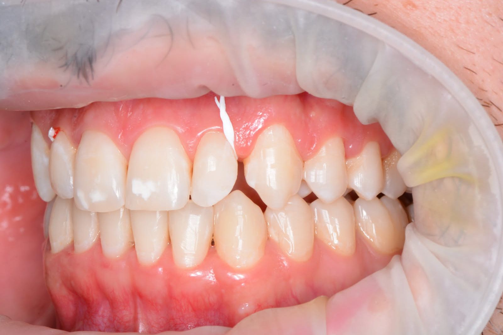 Before treatment