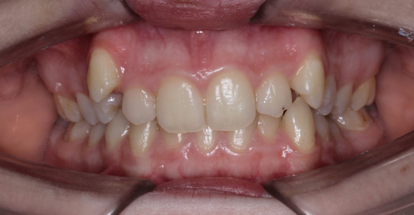 Before treatment