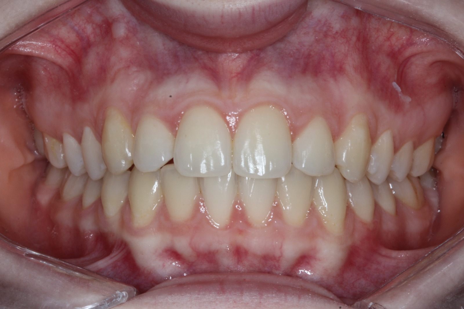 After treatment