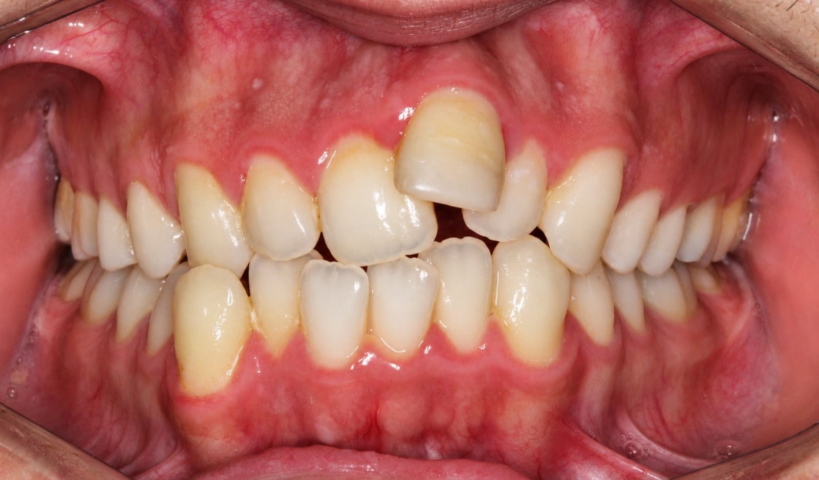 Before treatment